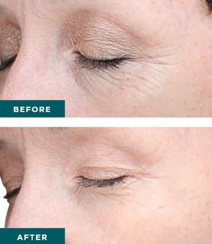 vipeel2