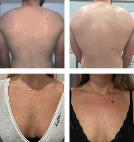 vipeel3